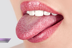 Лечение белого налета на языке