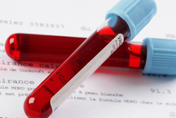 Показания к проедению анализа кровина ВИЧ